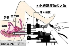 針を刺して、小さい放射性物質(シード)を埋め込む 針を刺して、小さい放射性物質(シード)を埋め込む
