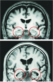 MRIによる脳画像。健康な人(上)に比べ、アルツハイマー型認知症患者は記憶に関連する海馬(丸で囲んだ部分)が萎縮している(小田陽彦医師提供) MRIによる脳画像。健康な人(上)に比べ、アルツハイマー型認知症患者は記憶に関連する海馬(丸で囲んだ部分)が萎縮している(小田陽彦医師提供)