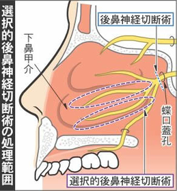 選択的後鼻神経切断術の処理範囲 選択的後鼻神経切断術の処理範囲