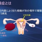 子宮内膜症とは(川口惠子医師提供)