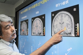 脳の炎症部位と症状の関係性が認められた研究成果を説明する渡辺恭良プログラムディレクター=神戸市中央区、理化学研究所 脳の炎症部位と症状の関係性が認められた研究成果を説明する渡辺恭良プログラムディレクター=神戸市中央区、理化学研究所