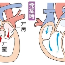 【からだ】ひょうごの医療「僧帽弁閉鎖不全症」