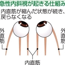【からだ】ひょうごの医療0201付「急性内斜