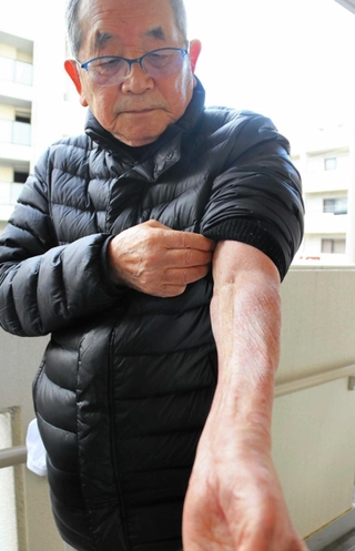 阪神・淡路大震災で倒壊した自宅の下敷きになり、１１時間後に救出された小田原達彦さん。左腕に痕が残る＝芦屋市内