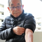阪神・淡路大震災で倒壊した自宅の下敷きになり、１１時間後に救出された小田原達彦さん。左腕に痕が残る＝芦屋市内
