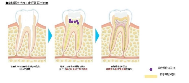 歯の神経組織「歯髄」と、その周辺組織「象牙質」を両方とも再生する治療法のイメージ図（エア・ウォーター提供）