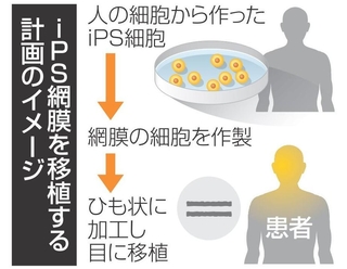 iPS網膜を移植する計画のイメージ