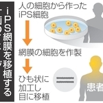 iPS網膜を移植する計画のイメージ