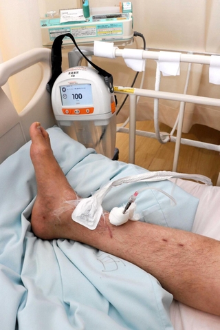 男性患者のすねに取り付けられた「ＣＬＡＰ療法」の器具。右側の管から抗菌薬を注入する＝姫路市神屋町３、兵庫県立はりま姫路総合医療センター