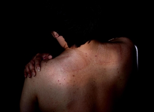 ２０年間、痛み止めの湿布薬を貼り続けた痕が肩から腰にかけて染みついている＝神戸市内