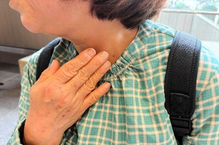 「甲状腺機能低下症」と診断された女性。甲状腺がある辺りに手を当てる＝大阪市内