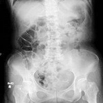 便秘患者の腹部のエックス線画像（兵庫県立大先端医療工学研究所提供）