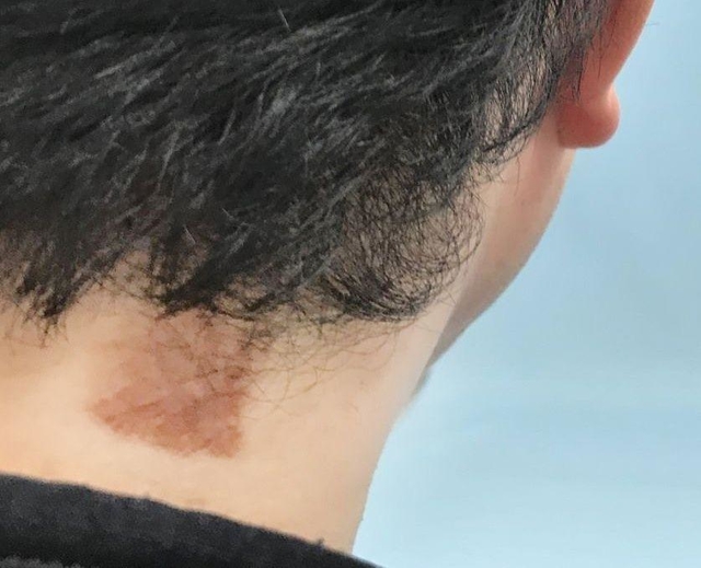 カメムシの臭い分泌液が付いて皮膚炎が起こった首の付け根部分。数日たち茶色い跡が残った