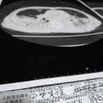 コロナウイルス肺炎などと書かれた診断書と、胸部のＣＴ画像のコピー