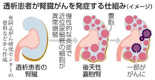 　透析患者が腎臓がんを発症する仕組み（イメージ）