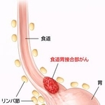 　食道胃接合部がんのイメージ図（大阪大の黒川幸典准教授提供）