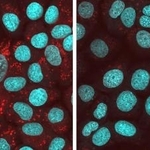 　細胞内にタンパク質「ＴＤＰ４３」の凝集体（赤色）が蓄積している状態（左）と、細胞に化合物を入れて凝集体の形成を抑えた様子（奈良県立医大、モルミル提供）