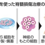 　ｉＰＳ細胞を使った脊髄損傷治療の臨床研究
