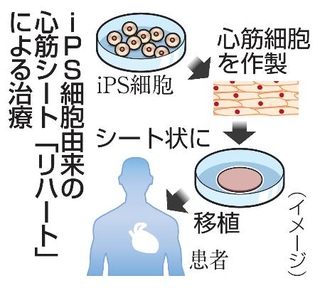 　ｉＰＳ細胞由来の心筋シート「リハート」による治療