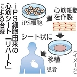 　ｉＰＳ細胞由来の心筋シート「リハート」による治療