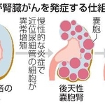 　透析患者が腎臓がんを発症する仕組み（イメージ）