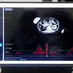 　ＡＩがＣＴ画像を解析するシステム「ＥＲＡＴＳ」の画面