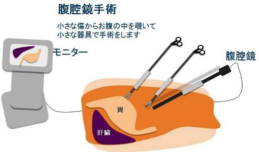 腹腔鏡手術のイメージ。小さな傷からお腹の中をのぞき、小さな器具で手術するので、体の負担が少ない（掛地吉弘・神戸大教授提供）