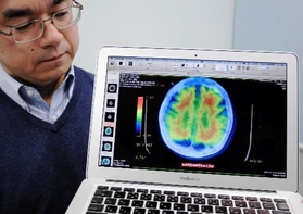 最新の画像検査で見たアルツハイマー型認知症とみられる人の脳。アミロイドβが赤で示されている＝神戸市中央区楠町７、神戸大医学部