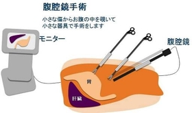 腹腔鏡手術のイメージ。小さな傷からお腹の中をのぞき、小さな器具で手術するので、体の負担が少ない（掛地吉弘・神戸大教授提供）