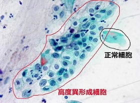子宮頸部の細胞。赤線で囲まれた部分の細胞は、黒線で囲まれた細胞に比べ核の占める割合が高い。形もふぞろいで放置するとがんになる「前がん細胞」の可能性がある（兵庫県立淡路医療センター提供）
