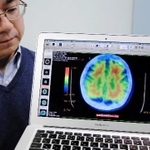 最新の画像検査で見たアルツハイマー型認知症とみられる人の脳。アミロイドβが赤で示されている＝神戸市中央区楠町７、神戸大医学部