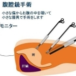 腹腔鏡手術のイメージ。小さな傷からお腹の中をのぞき、小さな器具で手術するので、体の負担が少ない（掛地吉弘・神戸大教授提供）
