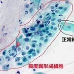子宮頸部の細胞。赤線で囲まれた部分の細胞は、黒線で囲まれた細胞に比べ核の占める割合が高い。形もふぞろいで放置するとがんになる「前がん細胞」の可能性がある（兵庫県立淡路医療センター提供）