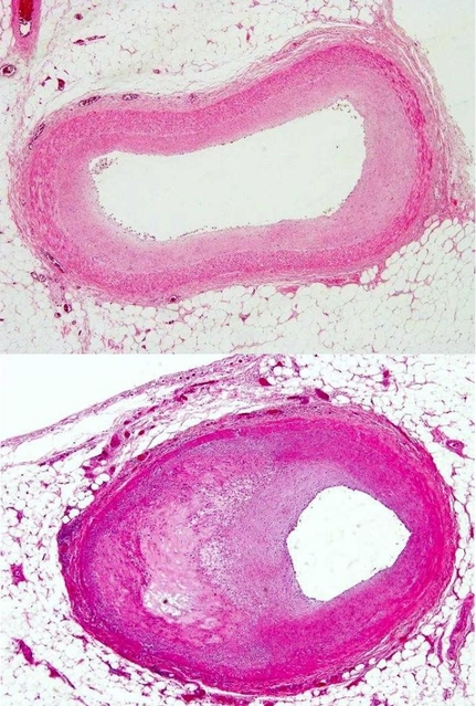 動脈硬化のない血管（上）に比べ、動脈硬化の進んだ血管（下）は内部が細くなっていることがよく分かる（平田健一副病院長提供）