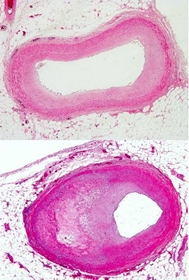 動脈硬化のない血管（上）に比べ、動脈硬化の進んだ血管（下）は内部が細くなっていることがよく分かる（平田健一副病院長提供）