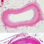 動脈硬化のない血管（上）に比べ、動脈硬化の進んだ血管（下）は内部が細くなっていることがよく分かる（平田健一副病院長提供）