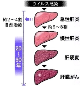 神戸新聞next ひょうごの医療 肝臓がん ラジオ波焼灼療法