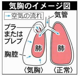 神戸新聞 ホーム|兵庫県内|医療|ひょうごの医療| シリーズ29 男性に多い病気 |男性に多い病気(1) 気胸