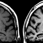 いずれも７０代の人の脳の磁気共鳴画像装置（ＭＲＩ）画像。健康な人（左）と比べ、アルツハイマー型認知症の人（右）の脳は萎縮が進み、隙間が多くなっているのが分かる（古和教授提供）
