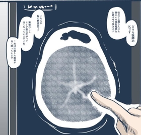 誰にでも起こりうるくも膜下出血の恐怖…（みもふさん提供）