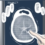 誰にでも起こりうるくも膜下出血の恐怖…（みもふさん提供）