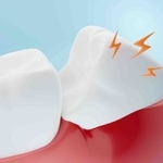 親知らずは手前の歯まで、むし歯のリスクが増す（piyaset/adobe.stock.com）