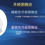 月経困難症とは（川口惠子医師提供）