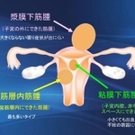 子宮筋腫（川口惠子医師提供）