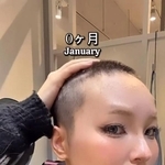 坊主にした直後（1月）のHANAさん／HANAさん（_hana8787_）提供