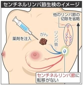 神戸新聞 ホーム 兵庫県内 医療 新ひょうごの医療 シリーズ４ がん診療最前線 ３ 乳がん 上 センチネルリンパ節生検