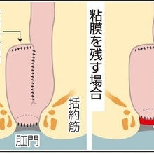 【からだ】潰瘍性大腸炎の手術